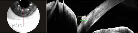 OCT imaging Vertical bscan (Solix™) of the lower lacrimal meniscus