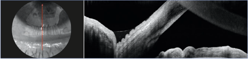 OCT imaging Bscan of the meniscus of lower tears highlighting