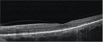 [Artigo do OCT] As coisas subtis são importantes quando se trata de certas doenças da retina Image