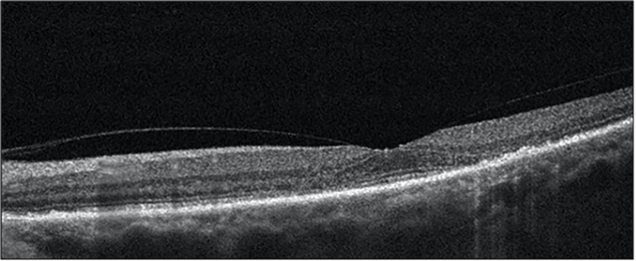 [Artigo do OCT] As coisas subtis são importantes quando se trata de certas doenças da retina Image