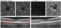 OCT vs. OCT-A: Assess retinal structure and function with advanced imaging technology  Image
