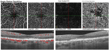 OCT vs. OCT-A: Assess retinal structure and function with advanced imaging technology  Image