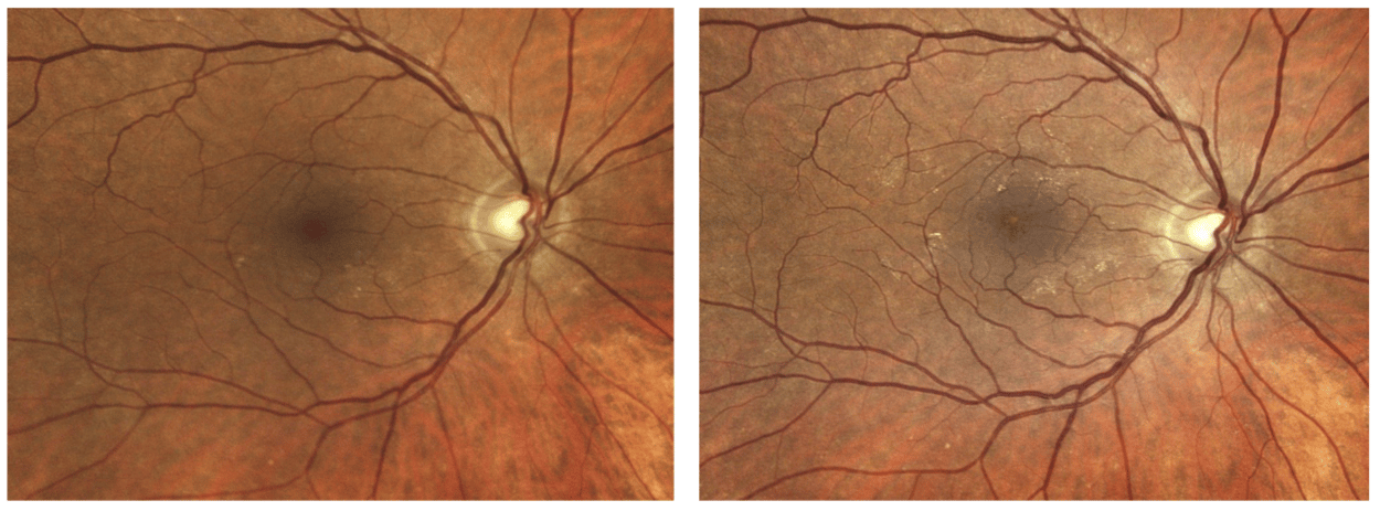 Case Study: Detection of Diabetic Macular Edema Despite Minimal Symptoms Image
