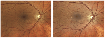 Case Study: Detection of Diabetic Macular Edema Despite Minimal Symptoms Image