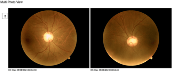 [OCT Observations] Protocole Glaucome Optovue Solix #2 Dr. Julie Rodman Image