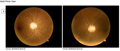 [OCT Observations] Optovue Solix Glaucoma Protocol #2 J.Rodman Image