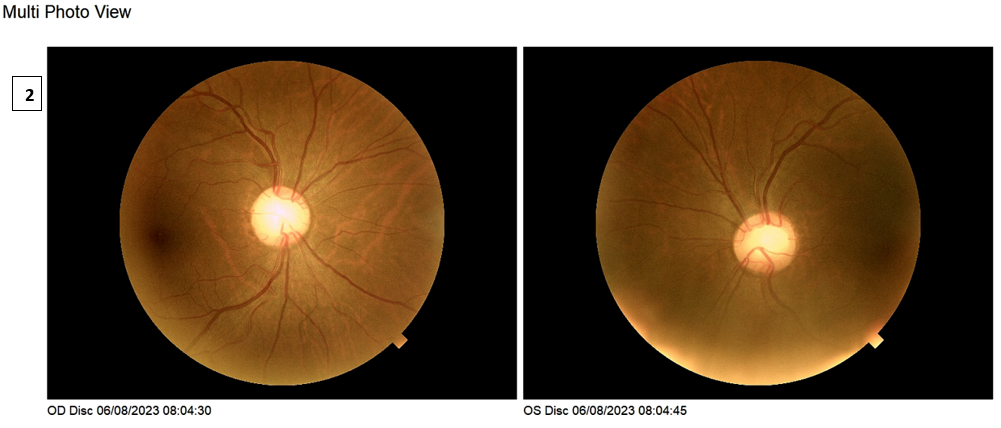 [OCT Observations] Optovue Solix Glaucoma Protocol #2 Dr. Julie Rodman Image