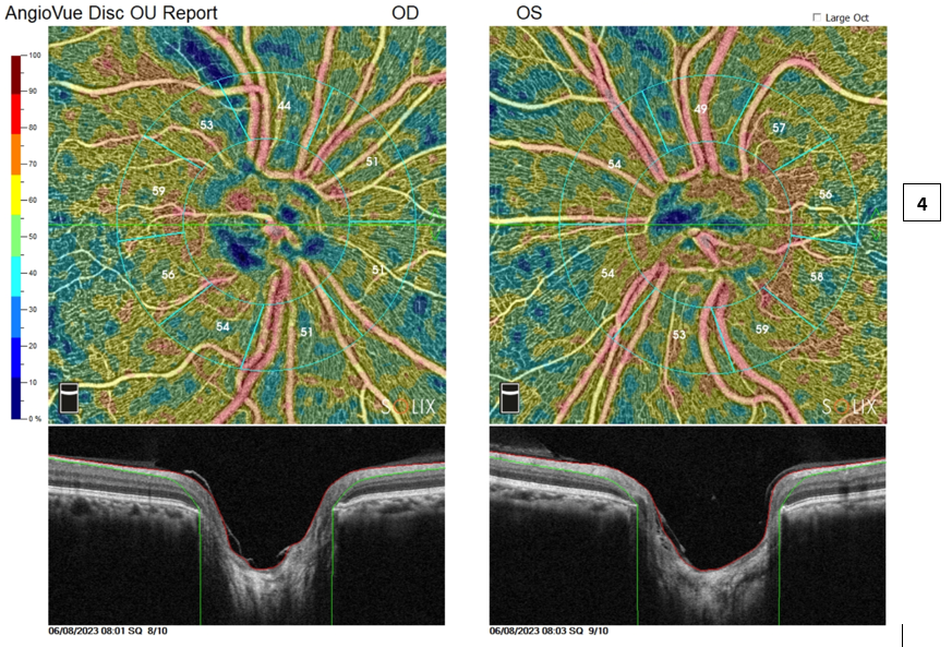 [OCT Observations] Protocole Glaucome Optovue Solix #2 Dr. Julie Rodman