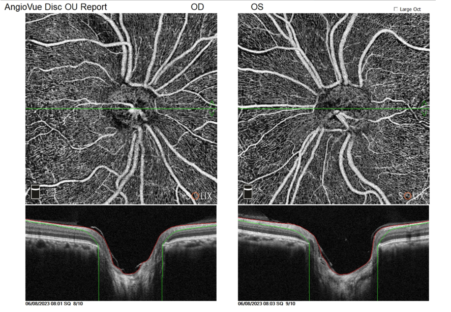 [OCT Observations] Optovue Solix Glaucoma Protocol #2 Dr. Julie Rodman