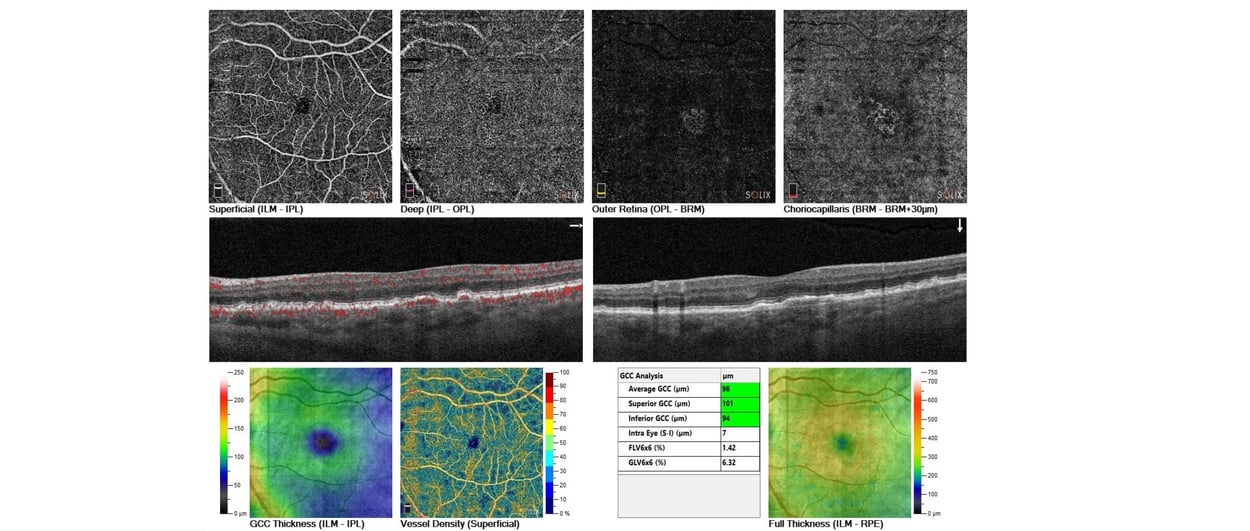 Case Study: Advanced AMD Monitoring using OCT-A Image
