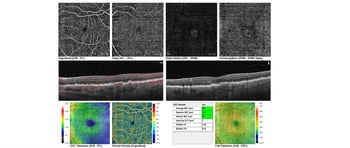 Case Study: Advanced AMD Monitoring using OCT-A Image