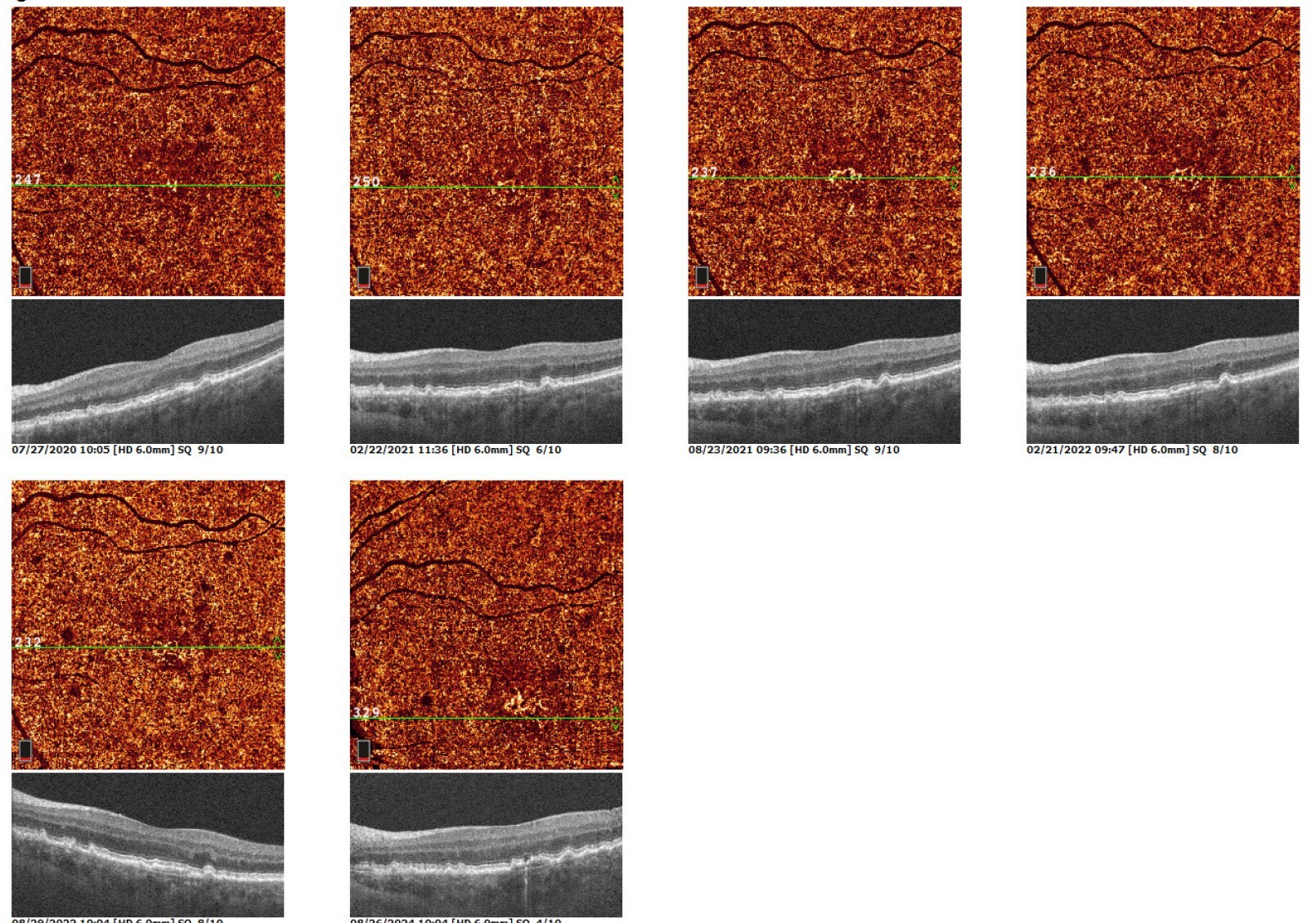 Case1AngioMultiScanOS