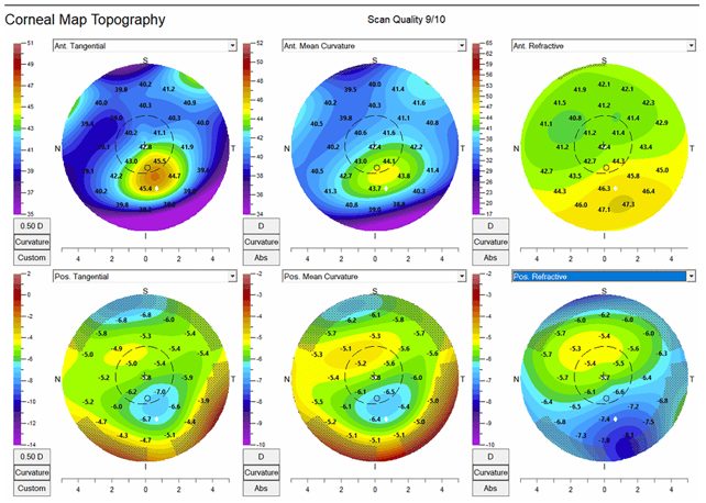 Corneal Map Topography - anterior posterior tangential