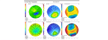 Case Study: Multiple Imaging Techniques to Detect Corneal Irregularities Image