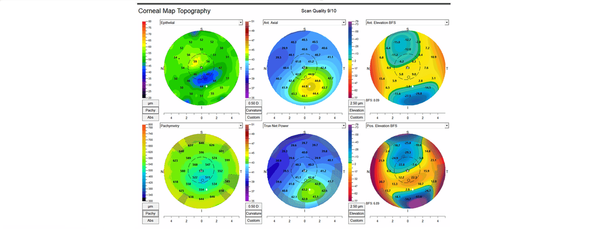 Case Study: Multiple Imaging Techniques to Detect Corneal Irregularities Image