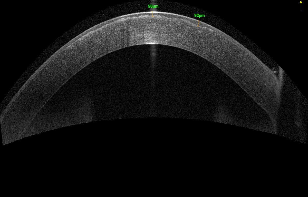 Fig. 3 Characteristic appearance of Optovue Solix OCT, with measurement using the caliper. This will enable precise guidance for the Trans-PKT (here, a total ablation depth of 90μ will be chosen).