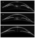 [Observaciones OCT] Utilización de exploraciones de la cámara anterior Full Range para el manejo del glaucoma Image