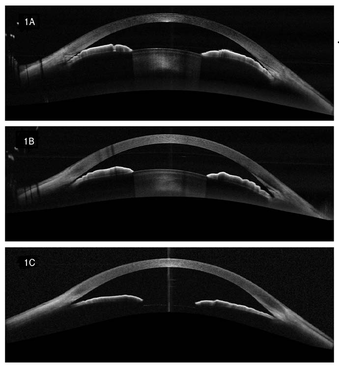 [OCT Observations] Utilizing Full-Range Anterior Chamber Scans in the Management of Glaucoma Image