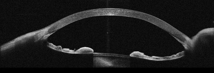 [OCT Observations] Utilizing Full-Range Anterior Chamber Scans in the ...