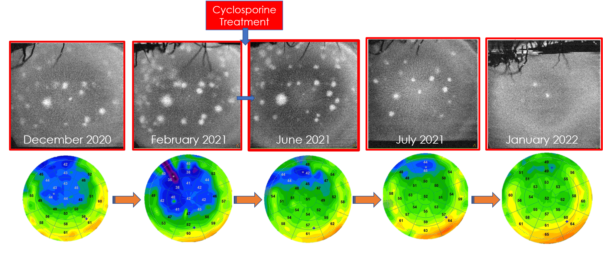 [OCT Article] Multimodal OCT Imaging of Adenovirus Keratitis by Adil El ...