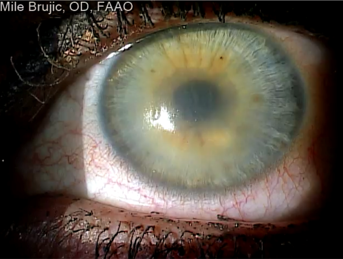 Figure 1. Significant corneal edema.