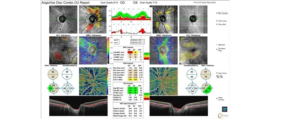 Case Study: OCT-A and Glaucoma Image