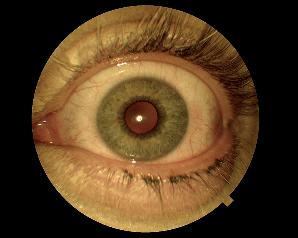 Figure 3. Picture of the patients left eye the following day.