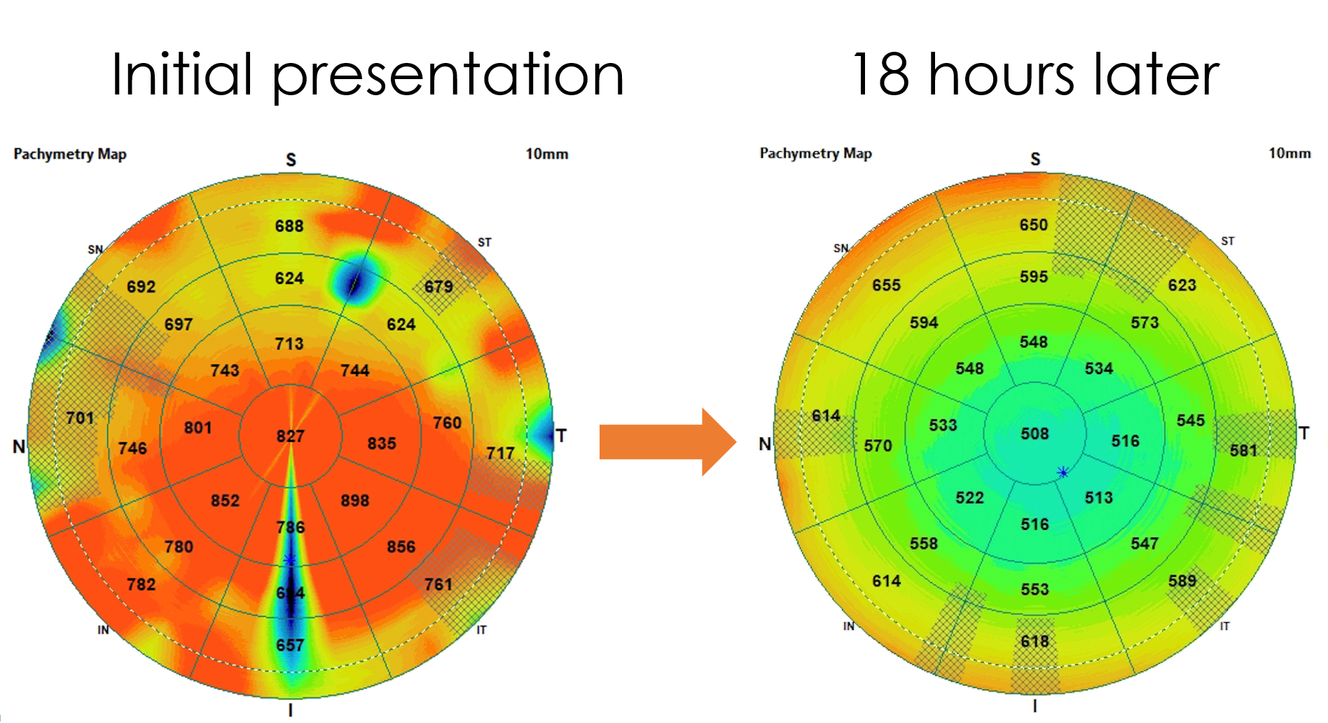Figure 4. Pachymetry scan at initial presentation