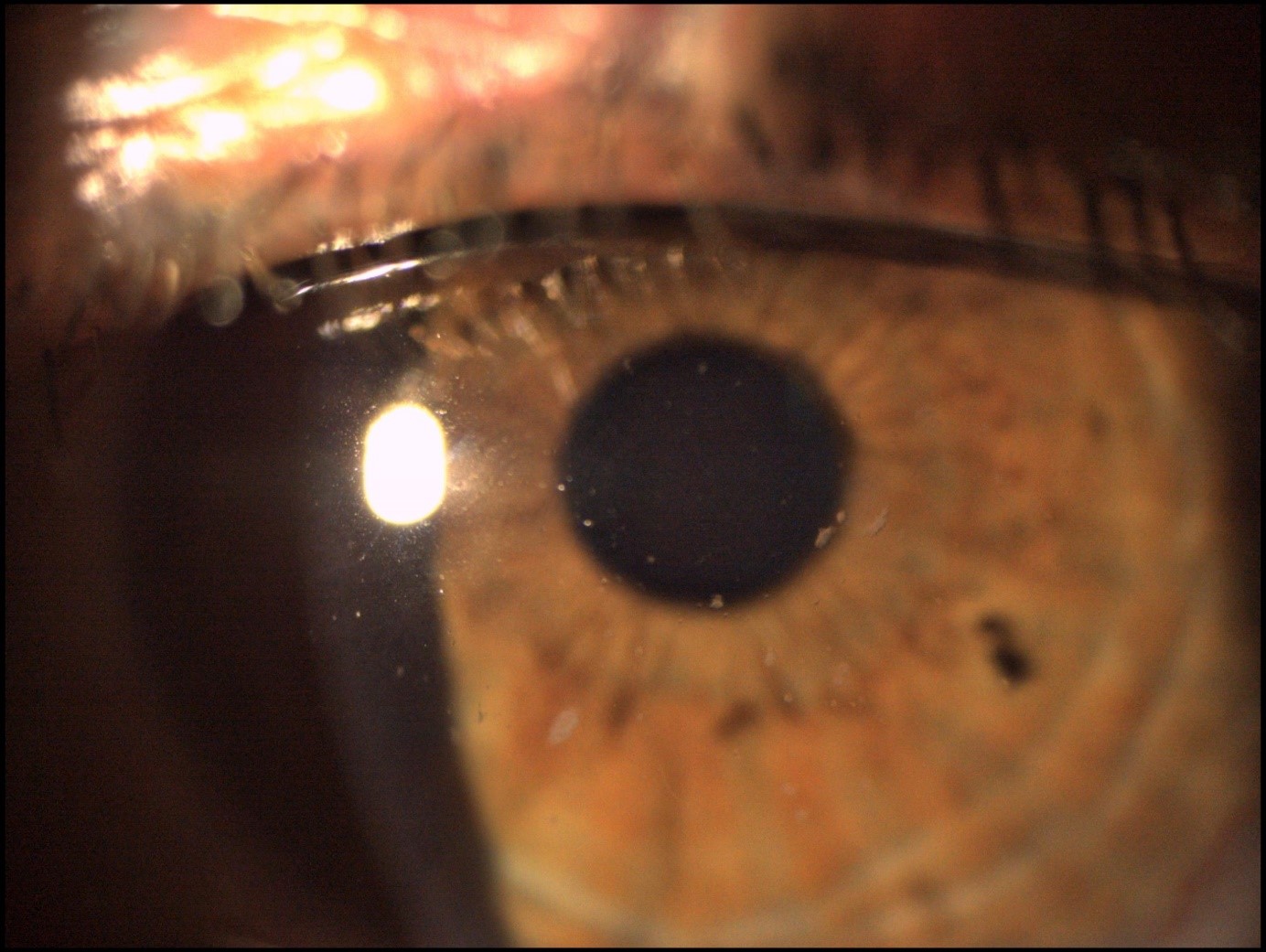 Figure 4. Postoperative slit-lamp image. Almost complete disappearance of corneal opacities.