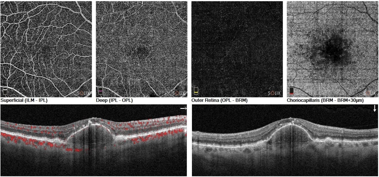Case Study: Using OCT-A to Rule Out CNV with Confidence Image
