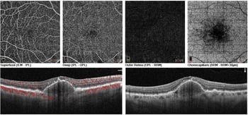 Case Study: Using OCT-A to Rule Out CNV with Confidence Image
