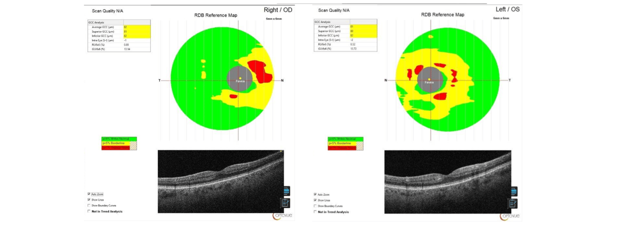 Case Study: Paracentral Acute Middle Maculopathy: Structural Recovery with Persistent Scotoma Image