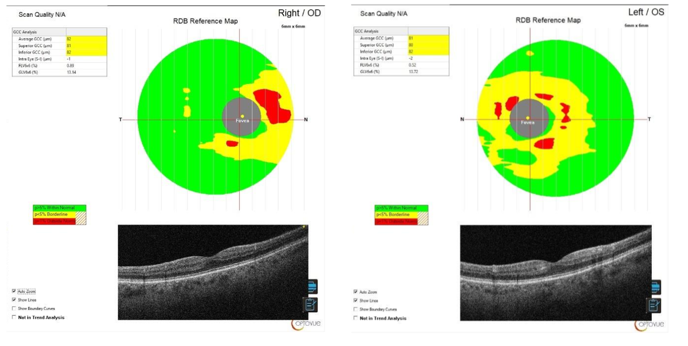 IPL Shaffer Case