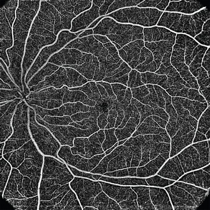 OCT vs. OCT-A: Assess retinal structure and function with advanced ...