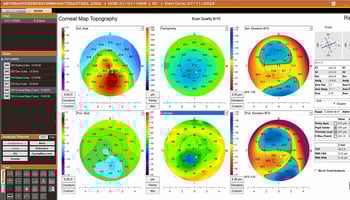 [OCT Comunicato stampa] Maggio 2025- Optovue Solix Topographia Image