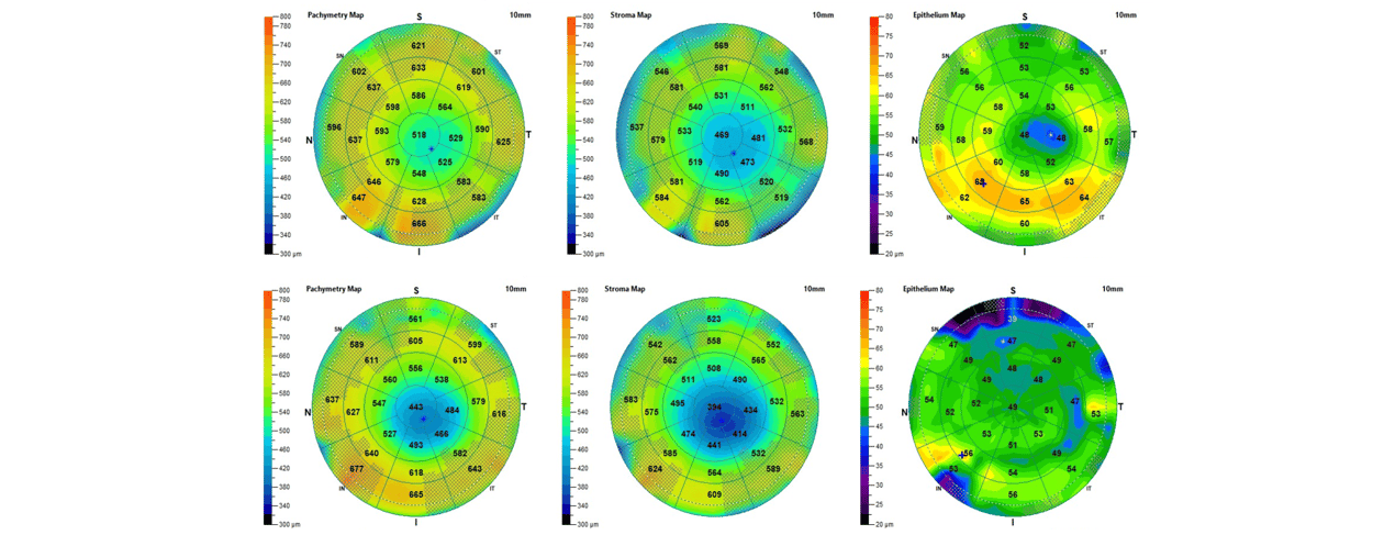 Case Study: Diagnosis and Treatment of Corneal HOA Utilizing Epithelial Compensation Mapping Image