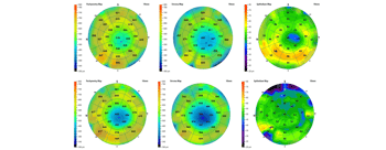 Case Study: Diagnosis and Treatment of Corneal HOA Utilizing Epithelial Compensation Mapping Image