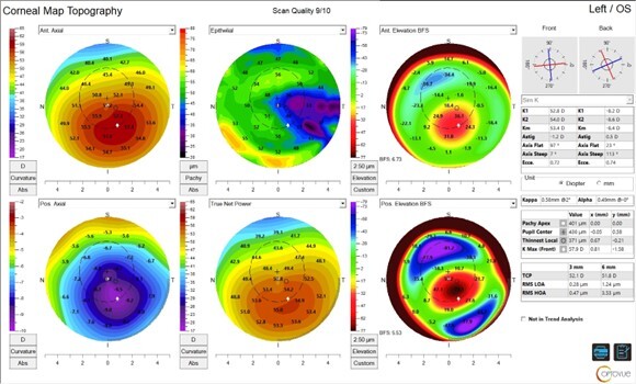 Corneal Topography - Optovue Solix