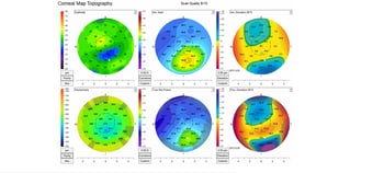 Case Study: Multiple Imaging Techniques to Detect Corneal Irregularities Image