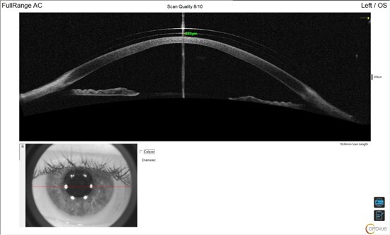 FullRange Anterior - Optovue Solix OCT