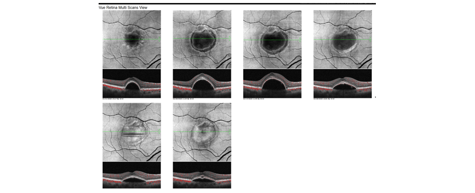 Case Study: Patient Resistant to Anti-VEGF Image