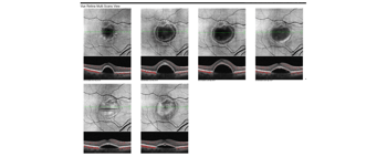 Case Study: Patient Resistant to Anti-VEGF Image