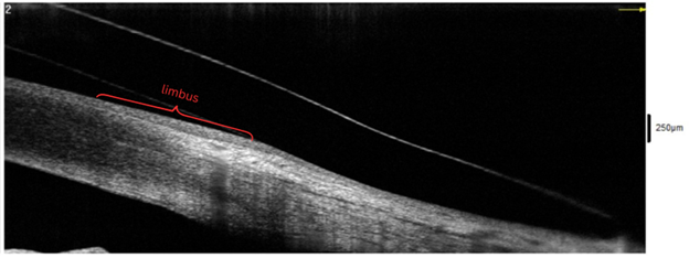 Case Study: Scleral Lens Simplicity: Utilizing Anterior Segment OCT for Scleral Lens Fitting Image