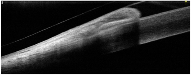 Optovue Solix OCT - Anterior Scan