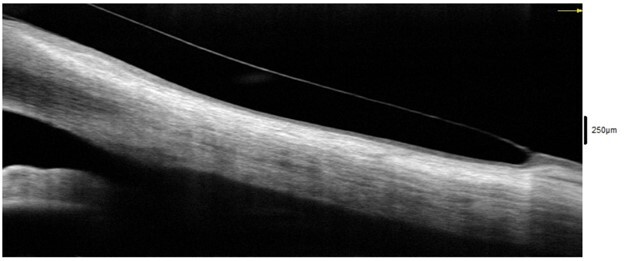 Optovue Solix OCT - Corneal Angle Scan 2