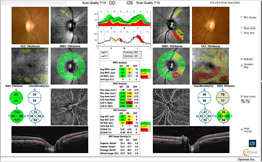 [OCT Aplicaciones] Protocolo Optovue Solix Glaucoma