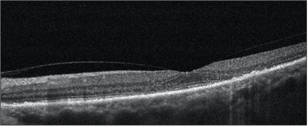 [OCT Article] Vitreous: Friend or Foe Image