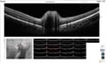 [OCT Article] Case Study: Advanced OCT Diagnostics for Buried Optic Nerve Head Drusen Image