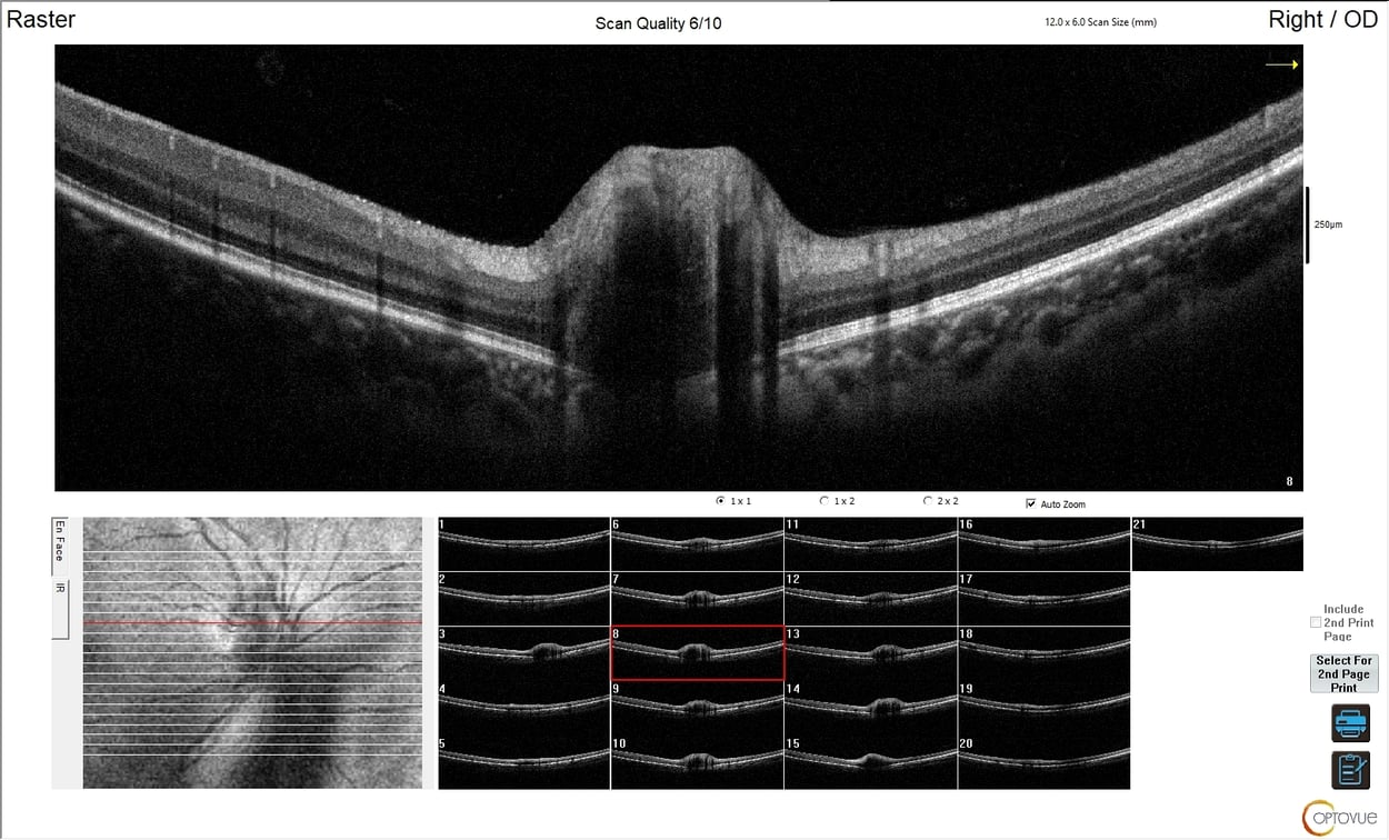 [OCT Article] Case Study: Advanced OCT Diagnostics for Buried Optic Nerve Head Drusen Image