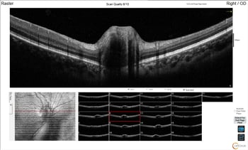 [OCT Article] Case Study: Advanced OCT Diagnostics for Buried Optic Nerve Head Drusen Image